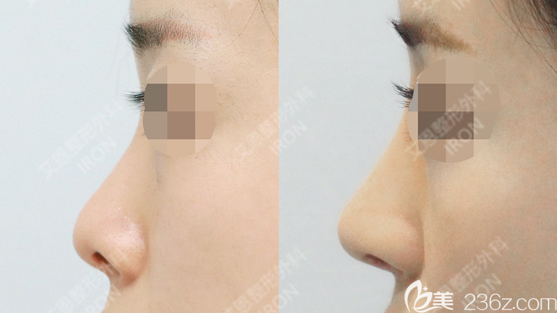 韓國艾恩整形隆鼻手術(shù)真人案例