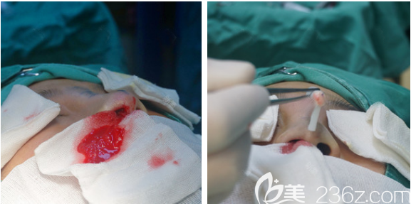 胸部奧美定全新取出方法 胸部奧美定全新取出方法