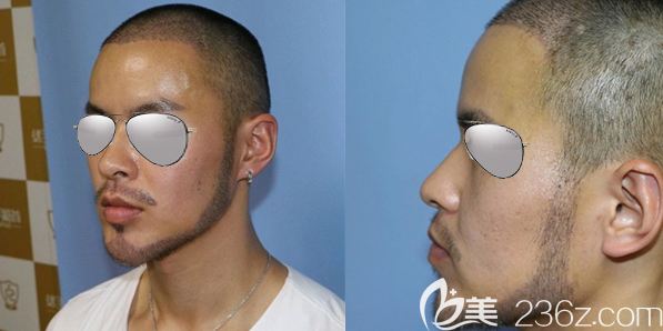 成都首瑞馬天順W型胡須種植術(shù)后7天恢復(fù)效果