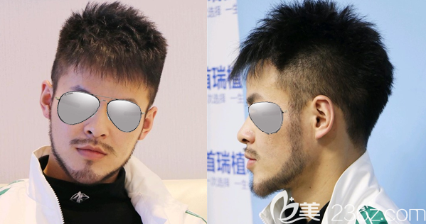 有了在成都首瑞種植w型胡須和鬢角種植的親身經歷，我輕松識破了“植胡須騙局”