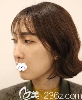 武漢硚口卓美吳秀英全臉埋線提升術(shù)前 武漢硚口卓美吳秀英全臉埋線提升術(shù)前