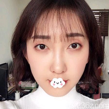 我比較青睞可吸收線才選擇武漢卓美做了大V線全臉埋線提升