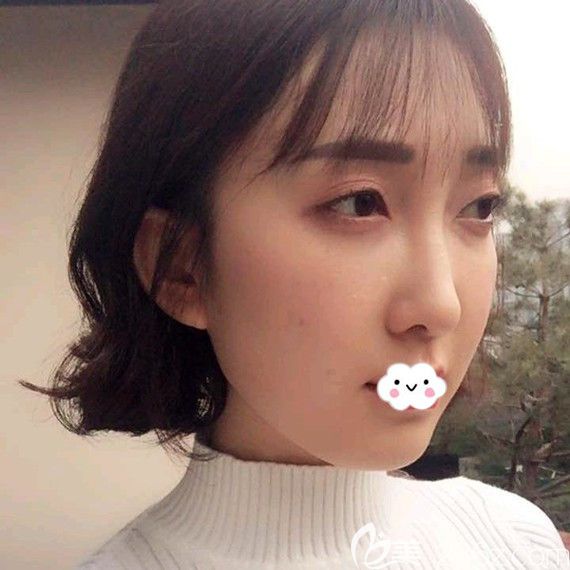 武漢卓美埋線提升術(shù)后側(cè)面恢復(fù)圖 武漢卓美埋線提升術(shù)后側(cè)面恢復(fù)圖