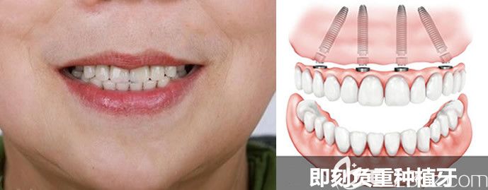 我在北京海德堡口腔做的即刻負重種植牙