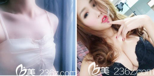 深圳富華整形醫(yī)院胡俊杰假體隆胸案例