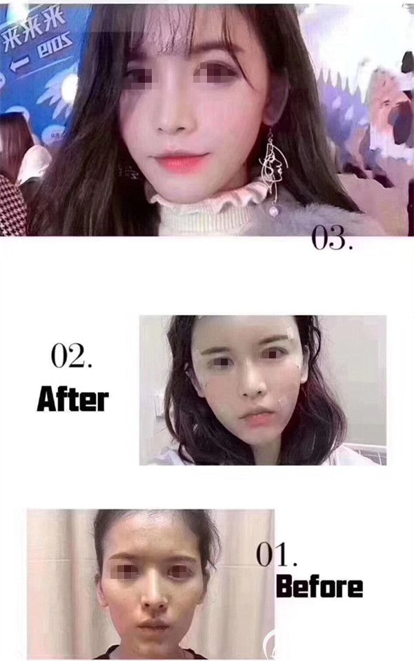 從術(shù)前到術(shù)中恢復(fù)階段到術(shù)后半年的時(shí)間，改變效果明顯