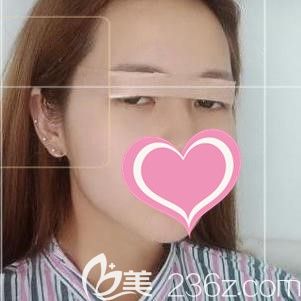 在壹美尚整形做小眼綜合術(shù)后即刻 在壹美尚整形做小眼綜合術(shù)后即刻