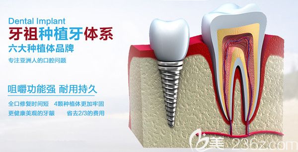 牙祖口腔種植體系