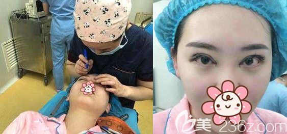 切開雙眼皮+開內(nèi)眼角手術(shù)+上瞼提肌等眼部綜合項目整形中