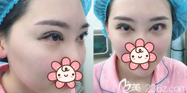 眼綜合做完第二天眼部充血腫脹