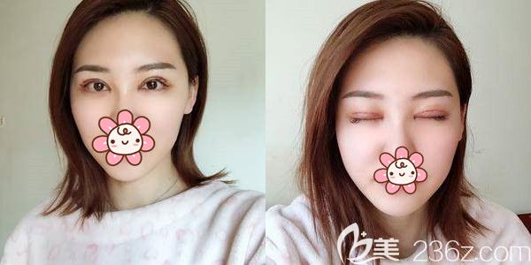 術(shù)后六天眼綜合恢復(fù)情況