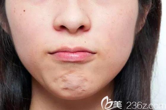 下巴吸脂術(shù)后凹凸不平