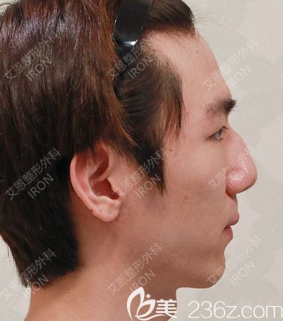 艾恩整形術(shù)前側(cè)面照 艾恩整形術(shù)前側(cè)面照