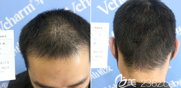 鄭州醫(yī)德佳梁愛峰PTT加密種植1個(gè)月效果 鄭州醫(yī)德佳梁愛峰PTT加密種植1個(gè)月效果