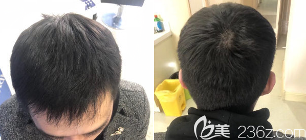 價(jià)格親民專業(yè)技術(shù)強(qiáng)是我在鄭州醫(yī)德佳做頭頂加密種植3500單位后的真實(shí)感受