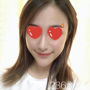 甩出在合肥做全臉脂肪填充術(shù)后45天照片，腫脹已消70%左右