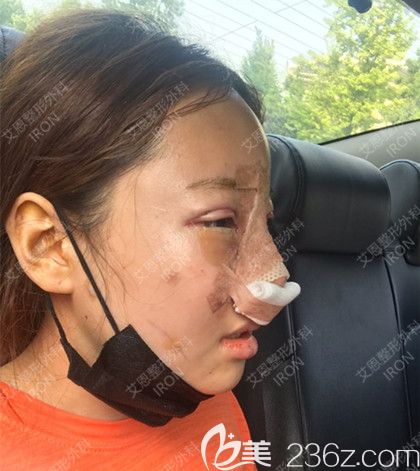 艾恩整形手術(shù)當(dāng)天