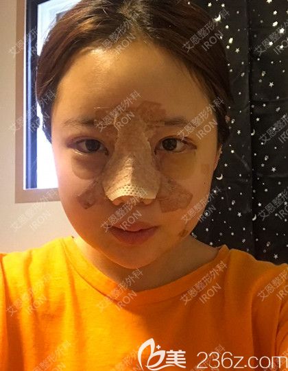 艾恩整形術(shù)后第6天