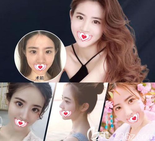 胡凱醫(yī)生做自體肋軟骨鼻綜合案例恢復過程圖