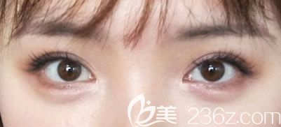 埋線雙眼皮一年后效果 埋線雙眼皮一年后效果