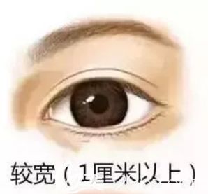 10毫米全切雙眼皮恢復(fù)后 10毫米全切雙眼皮恢復(fù)后