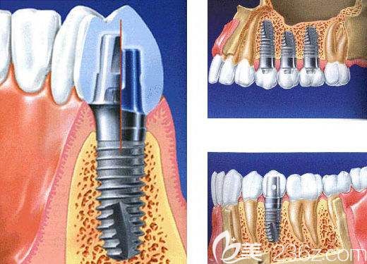 種植牙跟骨結(jié)合