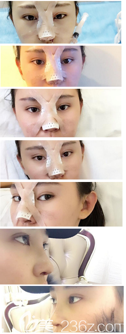 鼻綜合1-7天過程圖