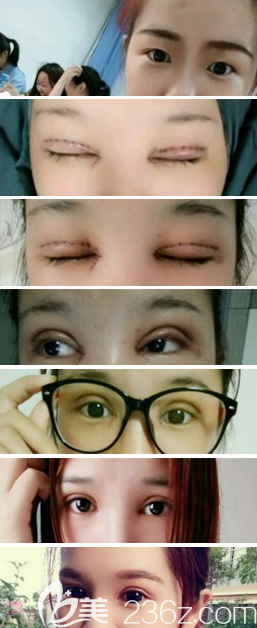 眼綜合術(shù)后1-7天過程圖