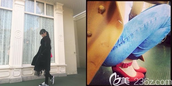 半個(gè)月以后大腿吸脂的恢復(fù)情況