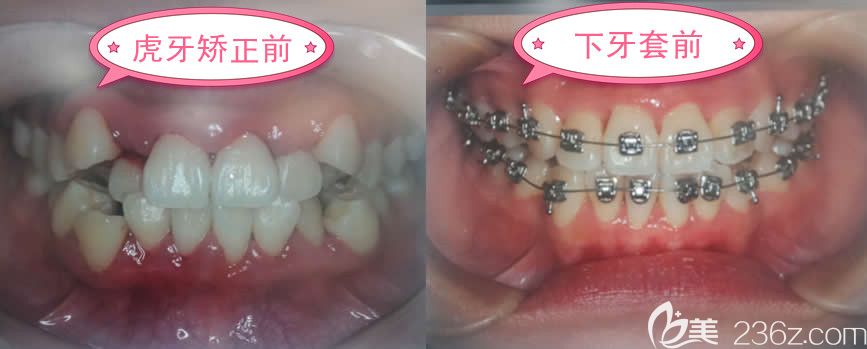 怎么也沒想到在福州維樂口腔戴自鎖金屬托槽牙套才花了15000元就矯正了虎牙