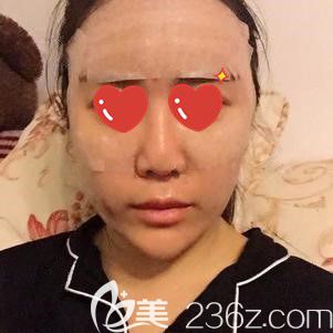 <!--<i data=20240703-sp></i>-->斐醫(yī)生幫我做自體脂肪面部填充術(shù)后即刻 <!--<i data=20240703-sp></i>-->斐醫(yī)生幫我做自體脂肪面部填充術(shù)后即刻