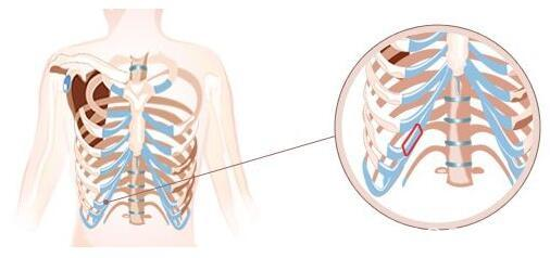 雖然鼻中隔軟骨隆鼻的吸收率只有2%左右但是大量取出會(huì)讓鼻子失去支撐力