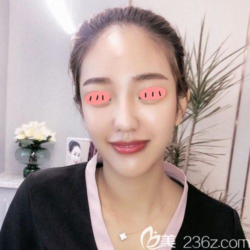 我天生塌鼻梁，自從找商丘冰薇張帥兵做膨體隆鼻后不再害怕隆鼻后遺癥