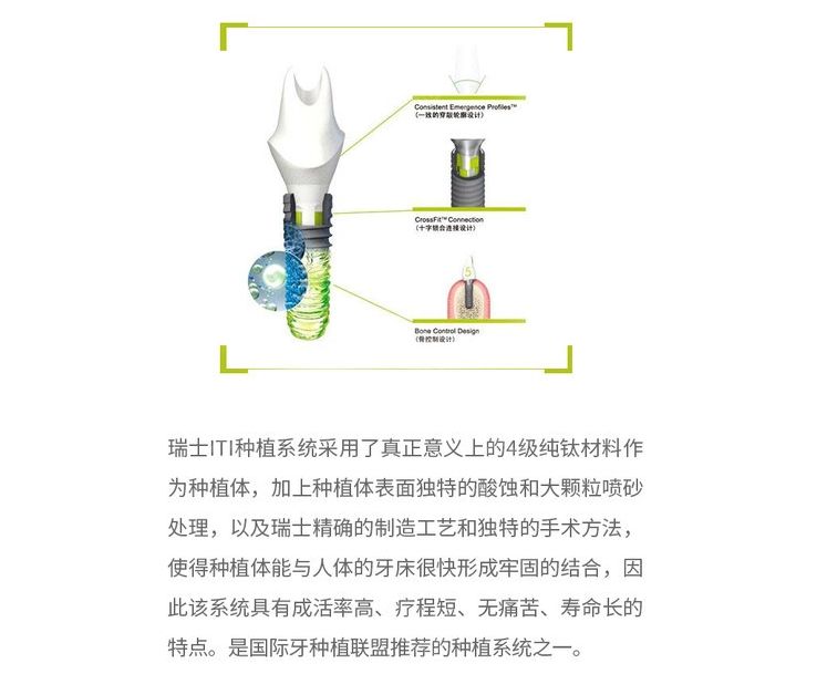 瑞士iti種植體優(yōu)點介紹 瑞士iti種植體優(yōu)點介紹