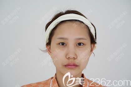 艾恩整形術(shù)前照 艾恩整形術(shù)前照