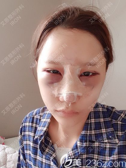 艾恩整形手術(shù)當(dāng)天照 艾恩整形手術(shù)當(dāng)天照