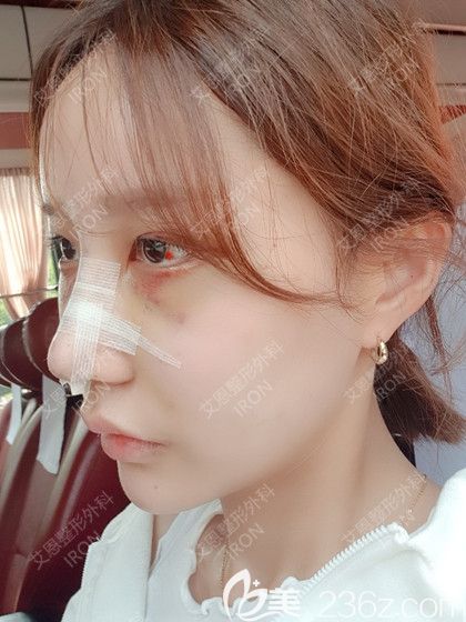 艾恩整形術(shù)后第7天 艾恩整形術(shù)后第7天