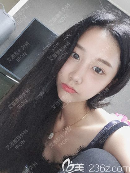 艾恩整形術(shù)后一個月 艾恩整形術(shù)后一個月