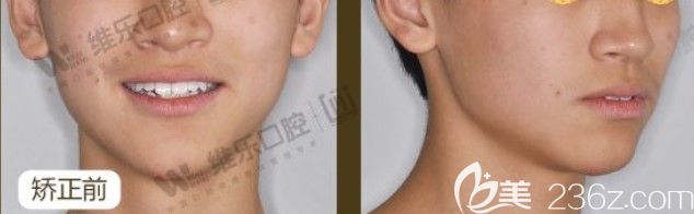 齙牙沒(méi)矯正之前的牙齒情況 齙牙沒(méi)矯正之前的牙齒情況