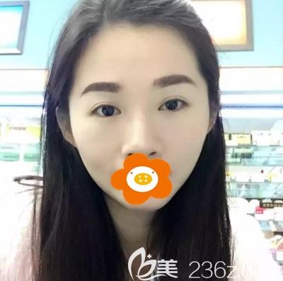 在廈門海峽做面部填充前的我 在廈門海峽做面部填充前的我