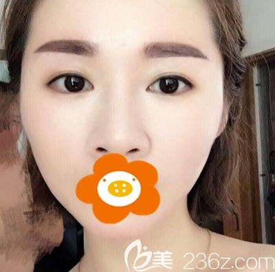 更新我在廈門華美做自體脂肪填充全臉恢復(fù)2個(gè)月的手術(shù)案例圖