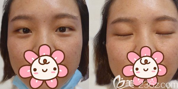 埋線雙眼皮一個月變內(nèi)雙 埋線雙眼皮一個月變內(nèi)雙