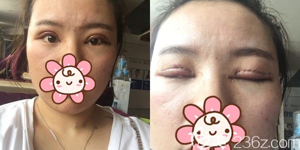 面診連云港華美醫(yī)生做了切開修復(fù) 面診連云港華美醫(yī)生做了切開修復(fù)