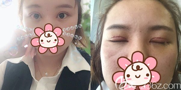 術(shù)后三天輕微消腫的雙眼皮 術(shù)后三天輕微消腫的雙眼皮