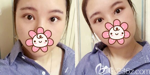 切開重瞼修復(fù)術(shù)后半個月恢復(fù) 切開重瞼修復(fù)術(shù)后半個月恢復(fù)