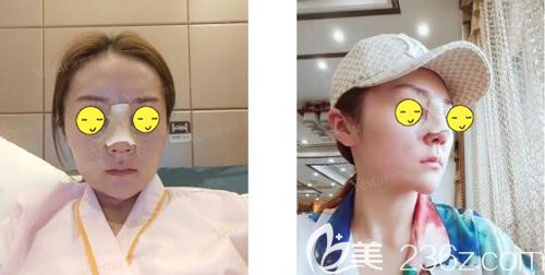 做肋軟骨鼻綜合術(shù)后即刻效果