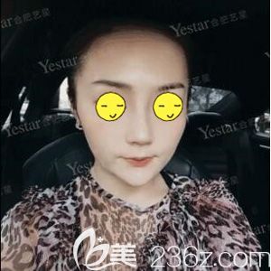 耿繼龍主任幫我做鼻綜合術(shù)后8天依舊腫脹