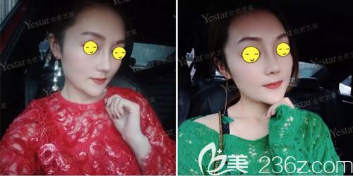 做肋軟骨鼻修復(fù)術(shù)后25天腫脹消除