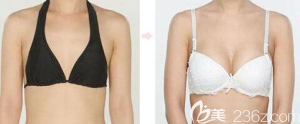 250cc曼托假體豐胸真人效果對(duì)比圖