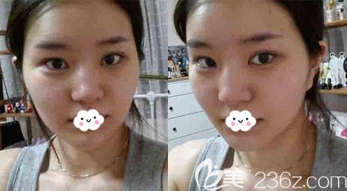 武漢卓美吳秀英耳軟骨復(fù)合隆鼻案例 武漢卓美吳秀英耳軟骨復(fù)合隆鼻案例